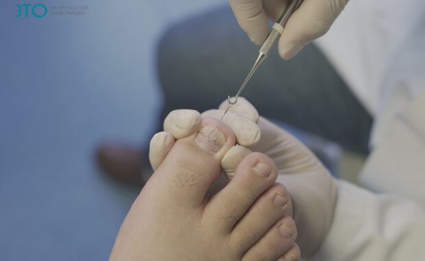 wrastający paznokieć co robić